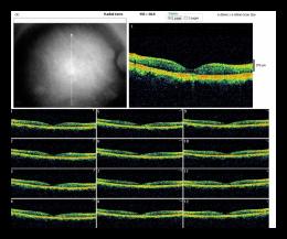 RADIAL LINE OD